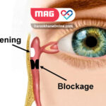 آشنایی با خطرات و مزایای جراحی انسداد مجرای اشکی
