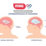 بررسی علمی بیماری هیدروسفالی و روش درمان آن