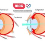 آستیگماتیسم چیست؟ بررسی علائم و روش های درمان