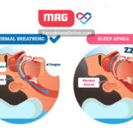 آپنه خواب یا تنگی نفس در خواب چیست؟ علائم، عوارض و درمان