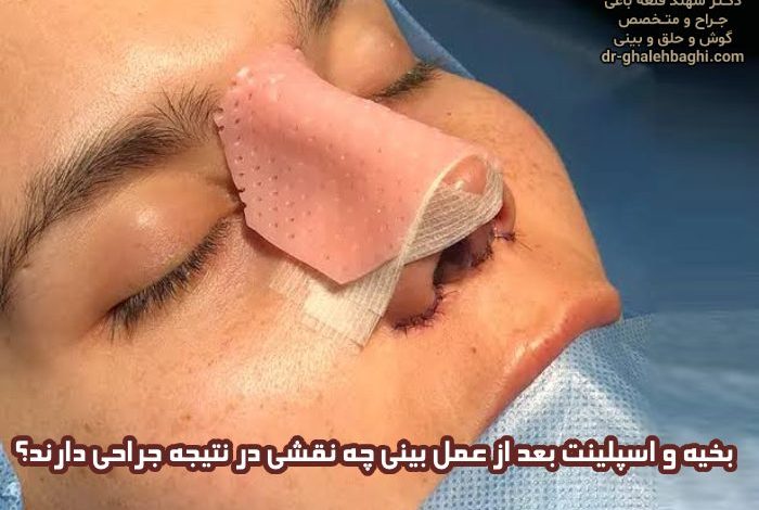 بخیه و اسپلینت بعد از عمل بینی چه نقشی در نتیجه جراحی دارند؟