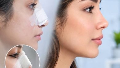چرا بینی تازه عمل شده، شبیه نتیجه نهایی نیست؟